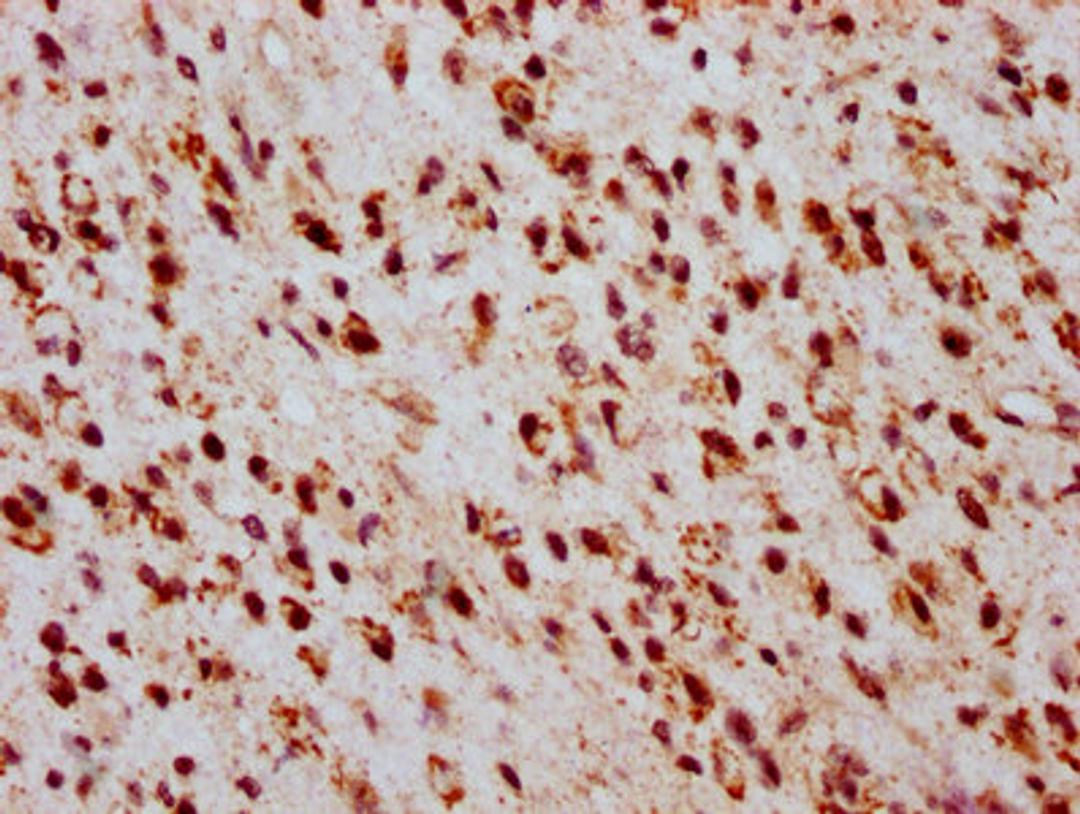 IHC image of CSB-PA010403OA05ncrHU diluted at 1:20 and staining in paraffin-embedded human glioma performed on a Leica BondTM system. After dewaxing and hydration, antigen retrieval was mediated by high pressure in a citrate buffer (pH 6.0). Section was blocked with 10% normal goat serum 30min at RT. Then primary antibody (1% BSA) was incubated at 4&deg;C overnight. The primary is detected by a biotinylated secondary antibody and visualized using an HRP conjugated SP system.