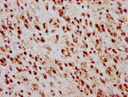 IHC image of CSB-PA010403OA05ncrHU diluted at 1:20 and staining in paraffin-embedded human glioma performed on a Leica BondTM system. After dewaxing and hydration, antigen retrieval was mediated by high pressure in a citrate buffer (pH 6.0). Section was blocked with 10% normal goat serum 30min at RT. Then primary antibody (1% BSA) was incubated at 4&deg;C overnight. The primary is detected by a biotinylated secondary antibody and visualized using an HRP conjugated SP system.