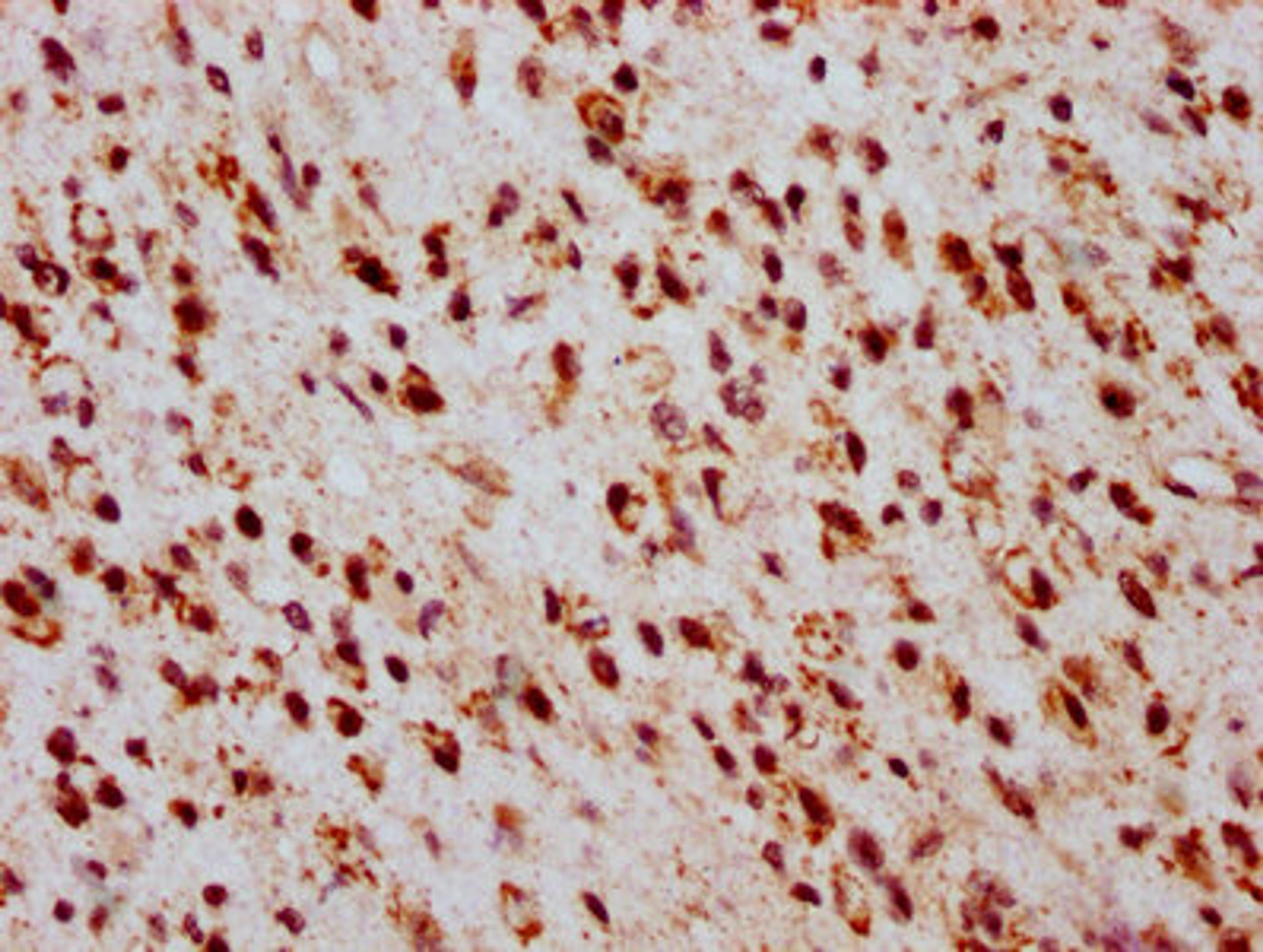 IHC image of CSB-PA010403OA05ncrHU diluted at 1:20 and staining in paraffin-embedded human glioma performed on a Leica BondTM system. After dewaxing and hydration, antigen retrieval was mediated by high pressure in a citrate buffer (pH 6.0). Section was blocked with 10% normal goat serum 30min at RT. Then primary antibody (1% BSA) was incubated at 4&deg;C overnight. The primary is detected by a biotinylated secondary antibody and visualized using an HRP conjugated SP system.