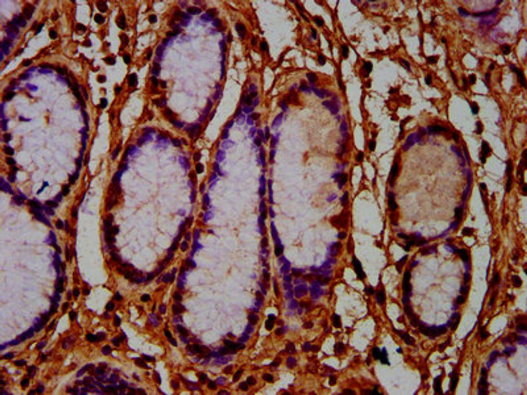 IHC image of CSB-PA880128LA01HU diluted at 1:600 and staining in paraffin-embedded human gastric cancer performed on a Leica BondTM system. After dewaxing and hydration, antigen retrieval was mediated by high pressure in a citrate buffer (pH 6.0). Section was blocked with 10% normal goat serum 30min at RT. Then primary antibody (1% BSA) was incubated at 4&deg;C overnight. The primary is detected by a biotinylated secondary antibody and visualized using an HRP conjugated SP system.