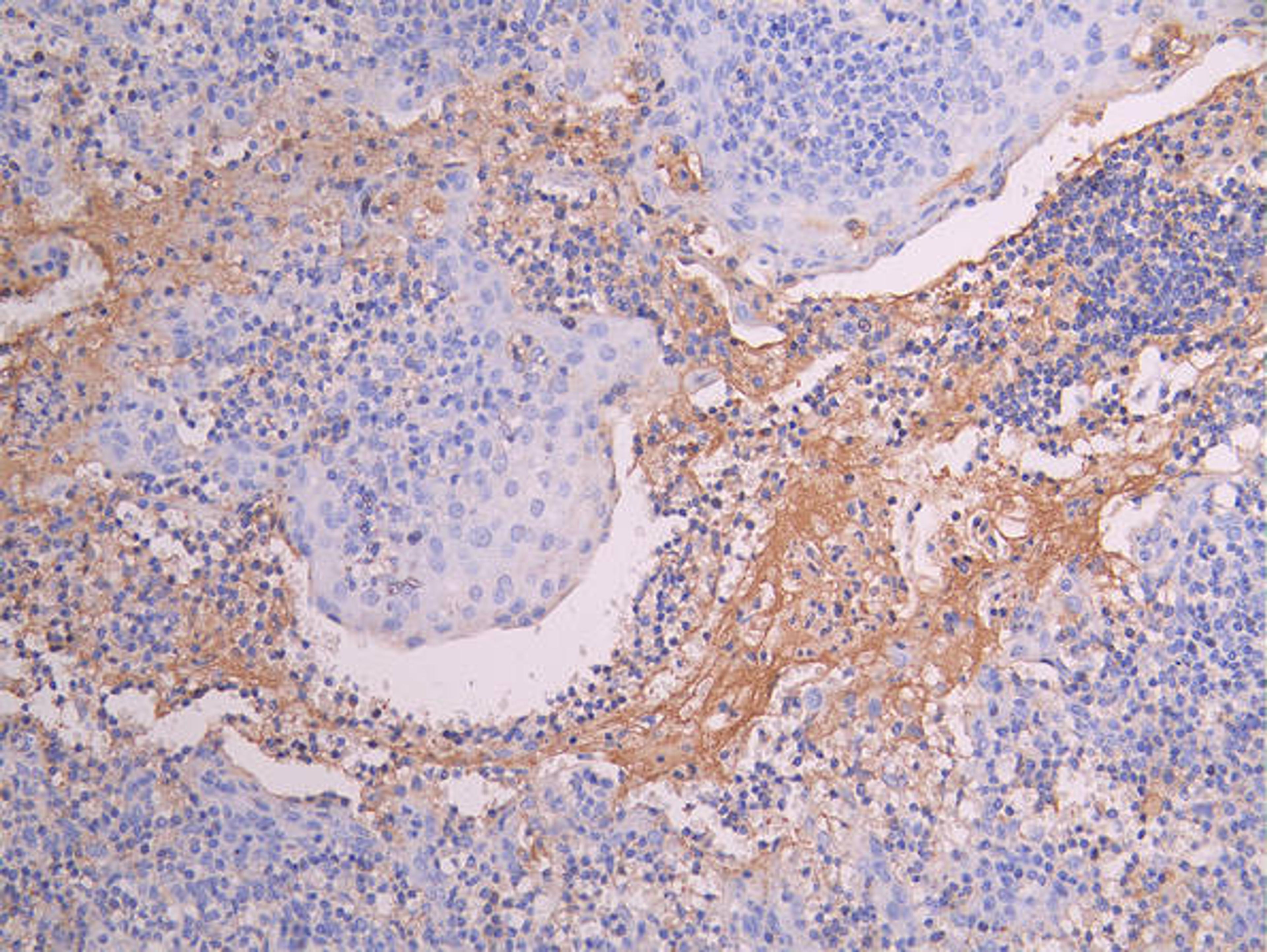 IHC image of CSB-RA014679MA1HU diluted at 1:150 and staining in paraffin-embedded human tonsil tissue performed on a Leica BondTM system. After dewaxing and hydration, antigen retrieval was mediated by high pressure in a citrate buffer (pH 6.0). Section was blocked with 10% normal goat serum 30min at RT. Then primary antibody (1% BSA) was incubated at 4°C overnight. The primary is detected by a Goat anti-human polymer IgG labeled by HRP and visualized using 0.05% DAB.