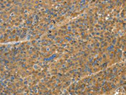 The image on the left is immunohistochemistry of paraffin-embedded Human liver cancer tissue using CSB-PA981923(TNFSF13B Antibody) at dilution 1/20, on the right is treated with fusion protein. (Original magnification: ×200)
