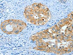 The image on the left is immunohistochemistry of paraffin-embedded Human cervical cancer tissue using CSB-PA556717(ANXA3 Antibody) at dilution 1/25, on the right is treated with fusion protein. (Original magnification: ×200)