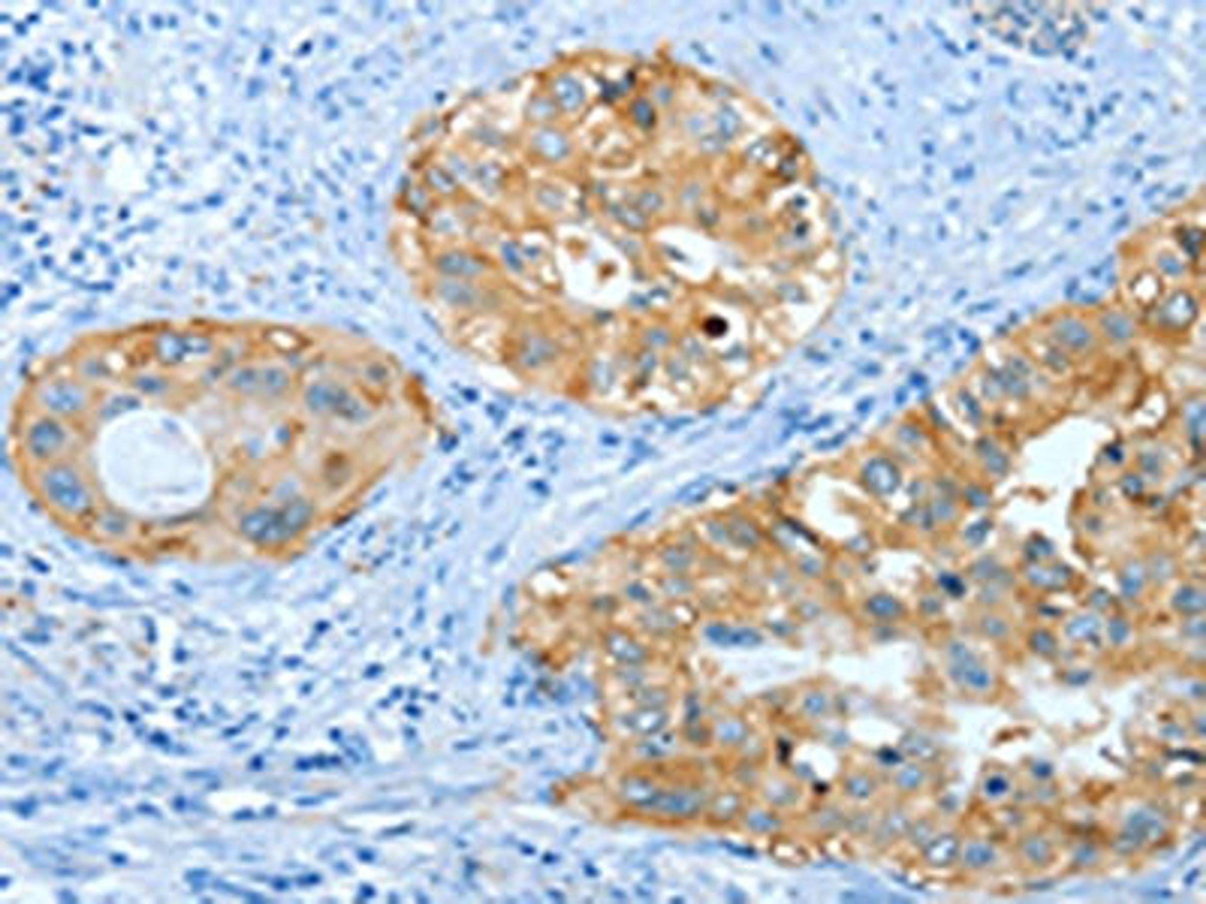 The image on the left is immunohistochemistry of paraffin-embedded Human cervical cancer tissue using CSB-PA556717(ANXA3 Antibody) at dilution 1/25, on the right is treated with fusion protein. (Original magnification: ×200)