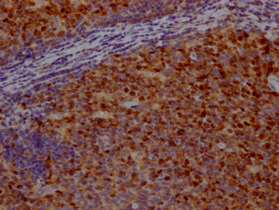 IHC image of CSB-RA209144A0HU diluted at 1:100 and staining in paraffin-embedded human tonsil tissue performed on a Leica BondTM system. After dewaxing and hydration, antigen retrieval was mediated by high pressure in a citrate buffer (pH 6.0). Section was blocked with 10% normal goat serum 30min at RT. Then primary antibody (1% BSA) was incubated at 4℃ overnight. The primary is detected by a Goat anti-rabbit IgG polymer labeled by HRP and visualized using 0.05% DAB.