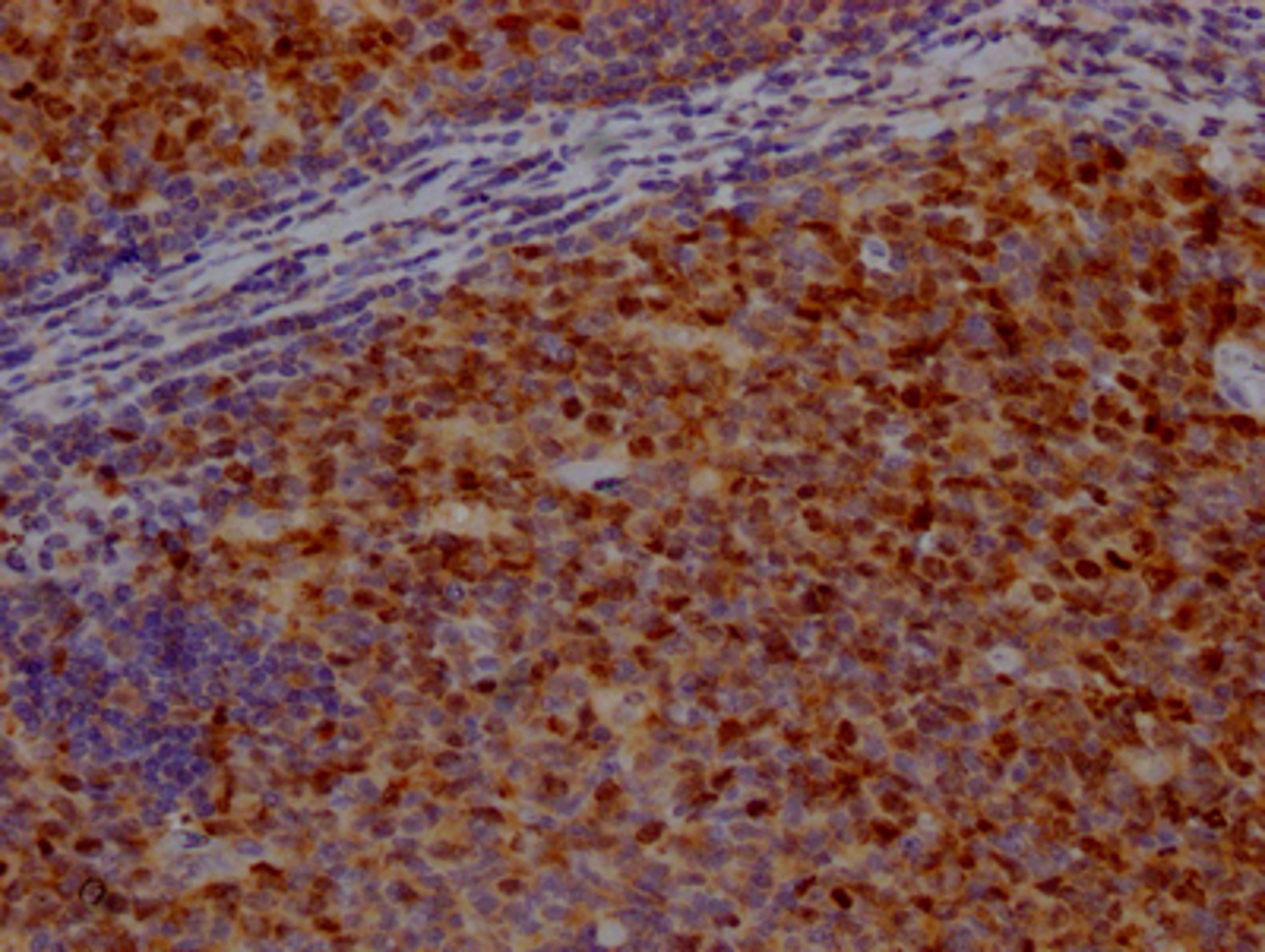 IHC image of CSB-RA209144A0HU diluted at 1:100 and staining in paraffin-embedded human tonsil tissue performed on a Leica BondTM system. After dewaxing and hydration, antigen retrieval was mediated by high pressure in a citrate buffer (pH 6.0). Section was blocked with 10% normal goat serum 30min at RT. Then primary antibody (1% BSA) was incubated at 4℃ overnight. The primary is detected by a Goat anti-rabbit IgG polymer labeled by HRP and visualized using 0.05% DAB.
