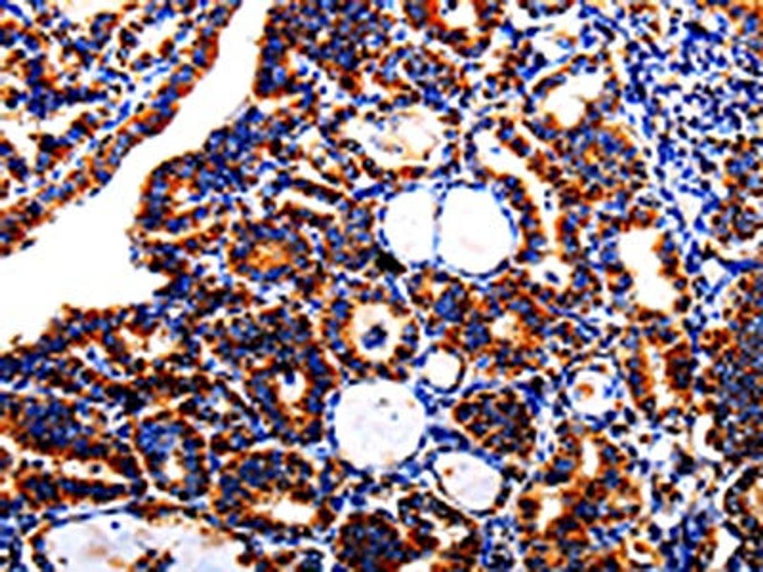 The image is immunohistochemistry of paraffin-embedded Human thyroid cancer tissue using CSB-PA230953(AFP Antibody) at dilution 1/40. (Original magnification: X200)