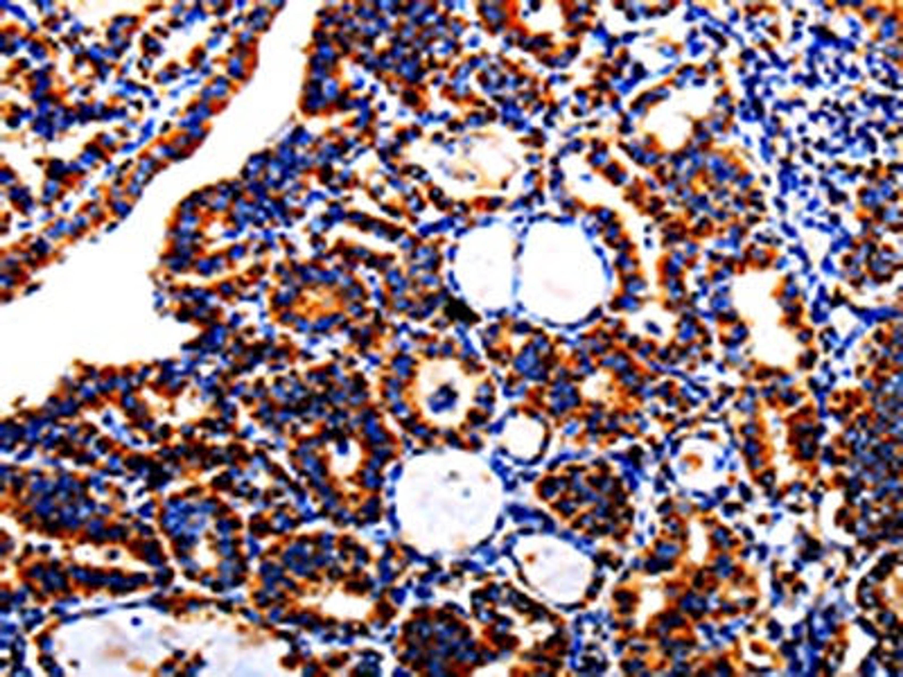 The image is immunohistochemistry of paraffin-embedded Human thyroid cancer tissue using CSB-PA230953(AFP Antibody) at dilution 1/40. (Original magnification: X200)