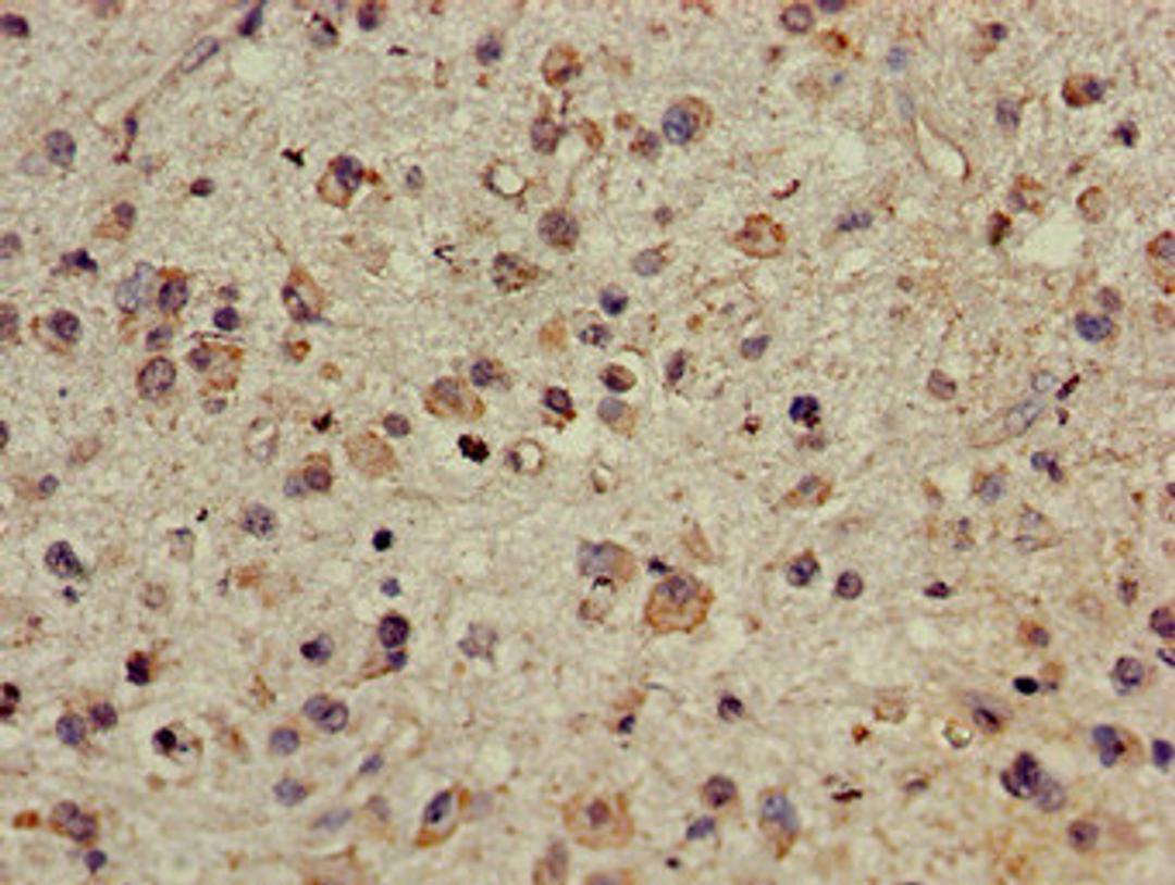 Immunohistochemistry of paraffin-embedded human glioma using CSB-PA896685LA01HU at dilution of 1:100