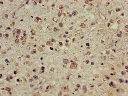 Immunohistochemistry of paraffin-embedded human glioma using CSB-PA896685LA01HU at dilution of 1:100