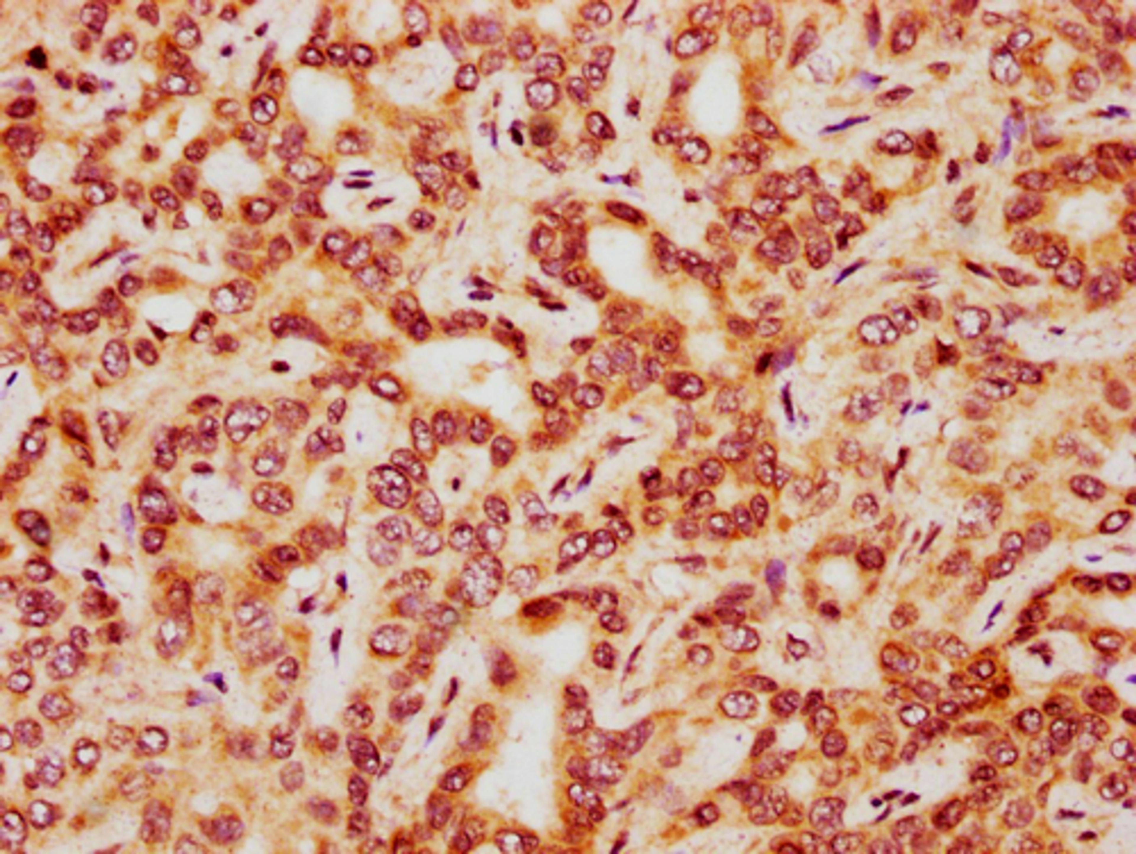 IHC image of CSB-PA010418PA41nphHU diluted at 1:20 and staining in paraffin-embedded human liver cancer performed on a Leica BondTM system. After dewaxing and hydration, antigen retrieval was mediated by high pressure in a citrate buffer (pH 6.0). Section was blocked with 10% normal goat serum 30min at RT. Then primary antibody (1% BSA) was incubated at 4°C overnight. The primary is detected by a biotinylated secondary antibody and visualized using an HRP conjugated SP system.