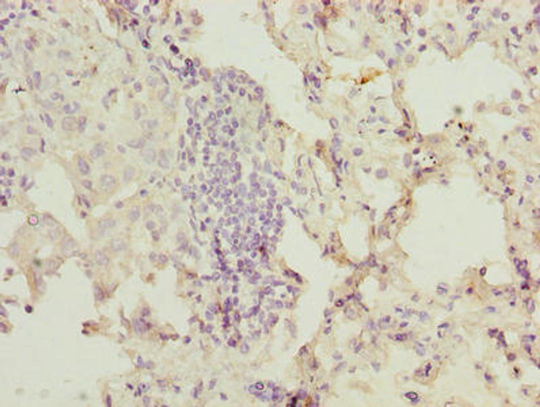 Immunohistochemistry of paraffin-embedded human lung cancer using CSB-PA016315LA01HU at dilution of 1:100