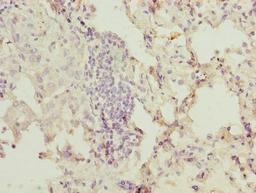 Immunohistochemistry of paraffin-embedded human lung cancer using CSB-PA016315LA01HU at dilution of 1:100