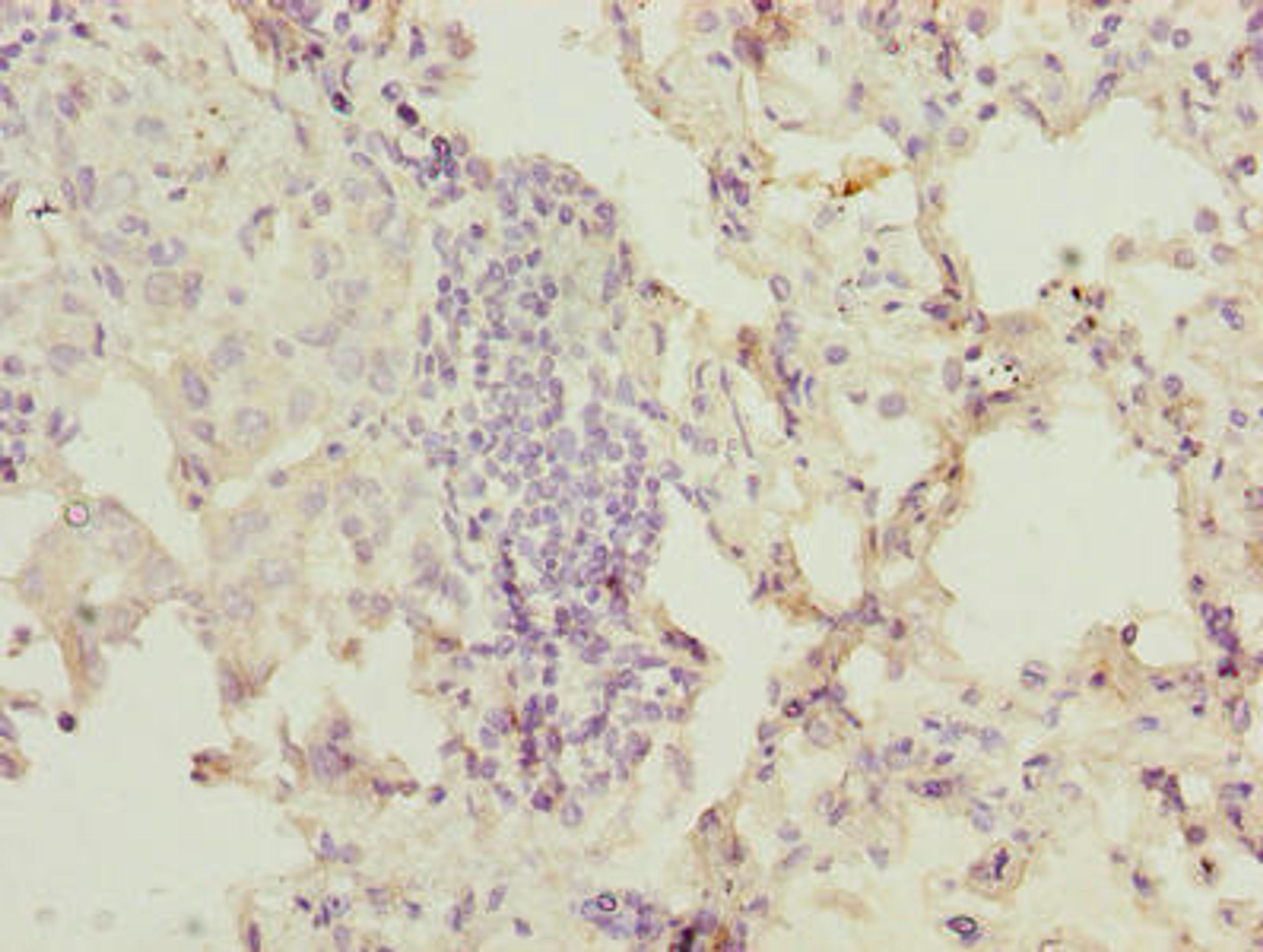 Immunohistochemistry of paraffin-embedded human lung cancer using CSB-PA016315LA01HU at dilution of 1:100