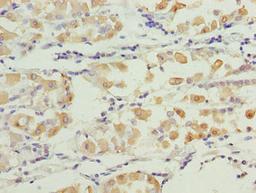 Immunohistochemistry of paraffin-embedded human gastric cancer using CSB-PA773032LA01HU at dilution of 1:100