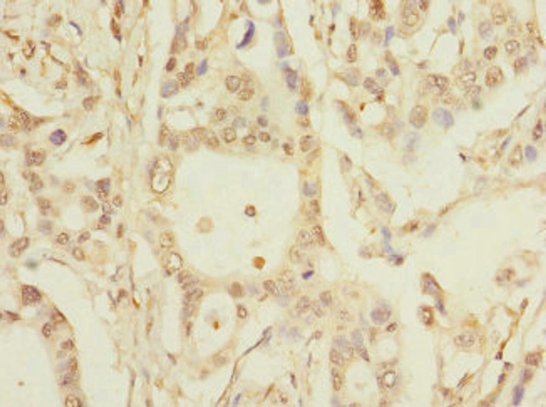 Immunohistochemistry of paraffin-embedded human pancreatic cancer using CSB-PA882158LA01HU at dilution of 1:100
