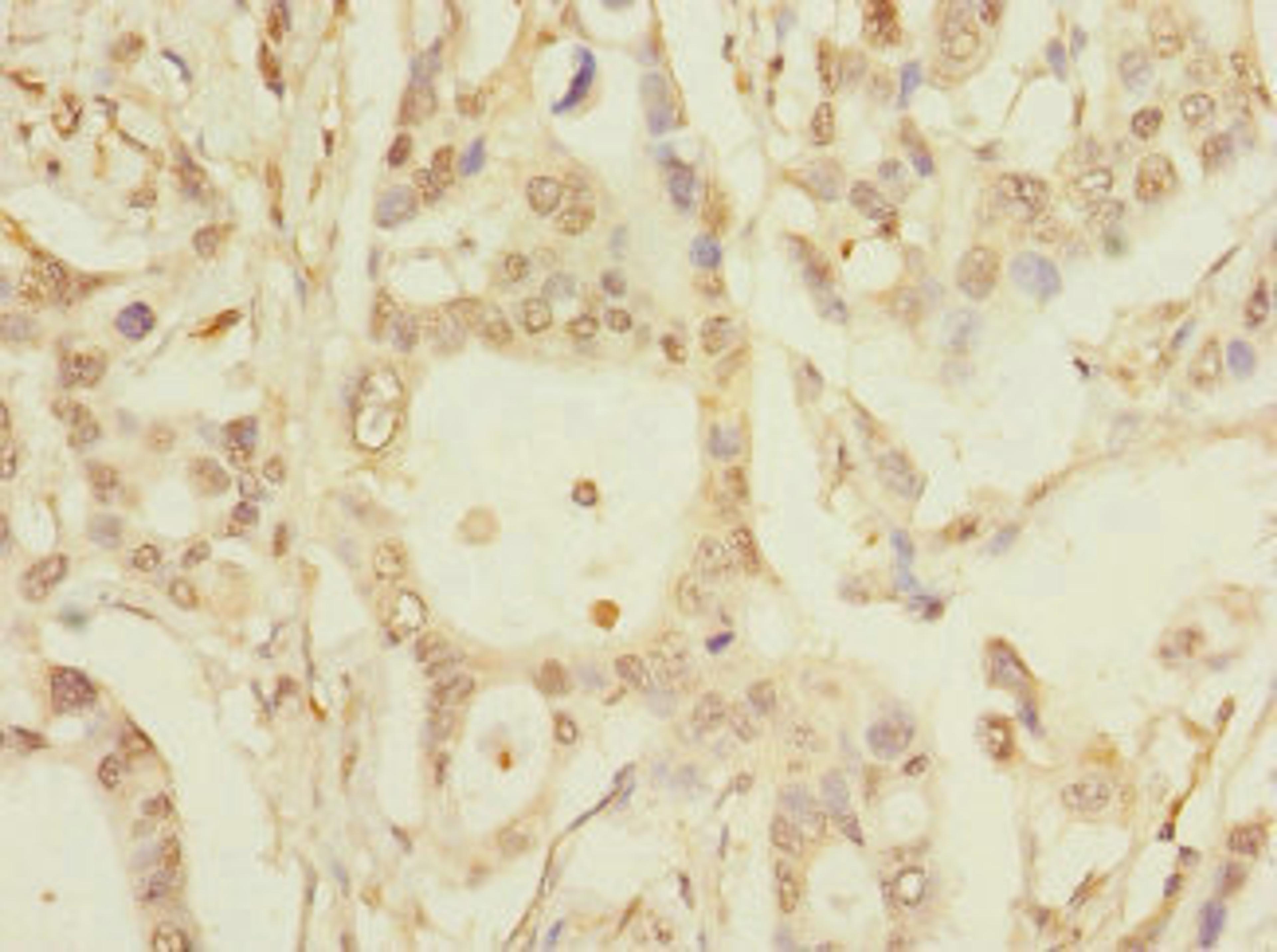 Immunohistochemistry of paraffin-embedded human pancreatic cancer using CSB-PA882158LA01HU at dilution of 1:100