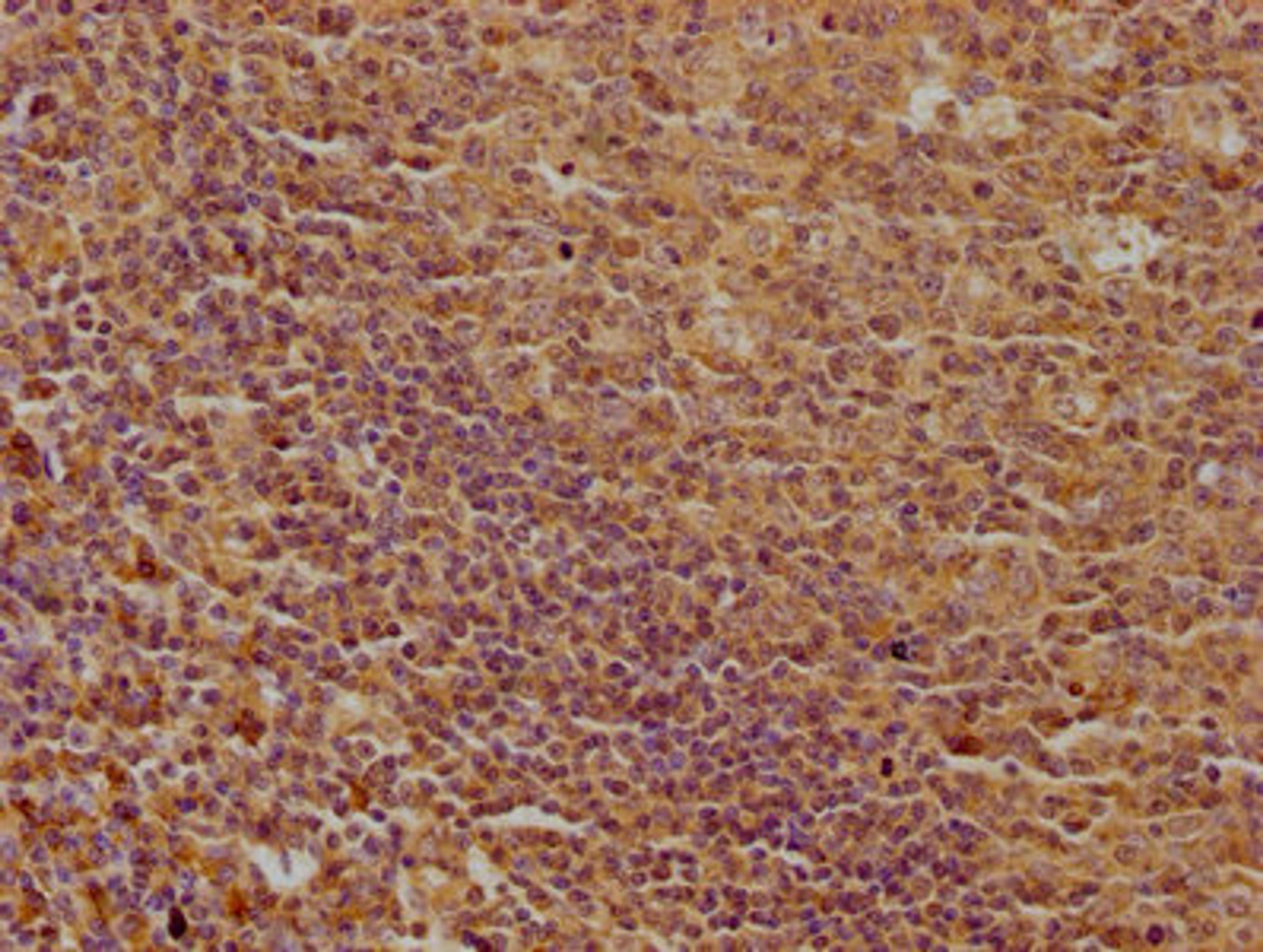 IHC image of CSB-PA013051OA01HU diluted at 1:100 and staining in paraffin-embedded human tonsil tissue performed on a Leica BondTM system. After dewaxing and hydration, antigen retrieval was mediated by high pressure in a citrate buffer (pH 6.0). Section was blocked with 10% normal goat serum 30min at RT. Then primary antibody (1% BSA) was incubated at 4°C overnight. The primary is detected by a biotinylated secondary antibody and visualized using an HRP conjugated SP system.