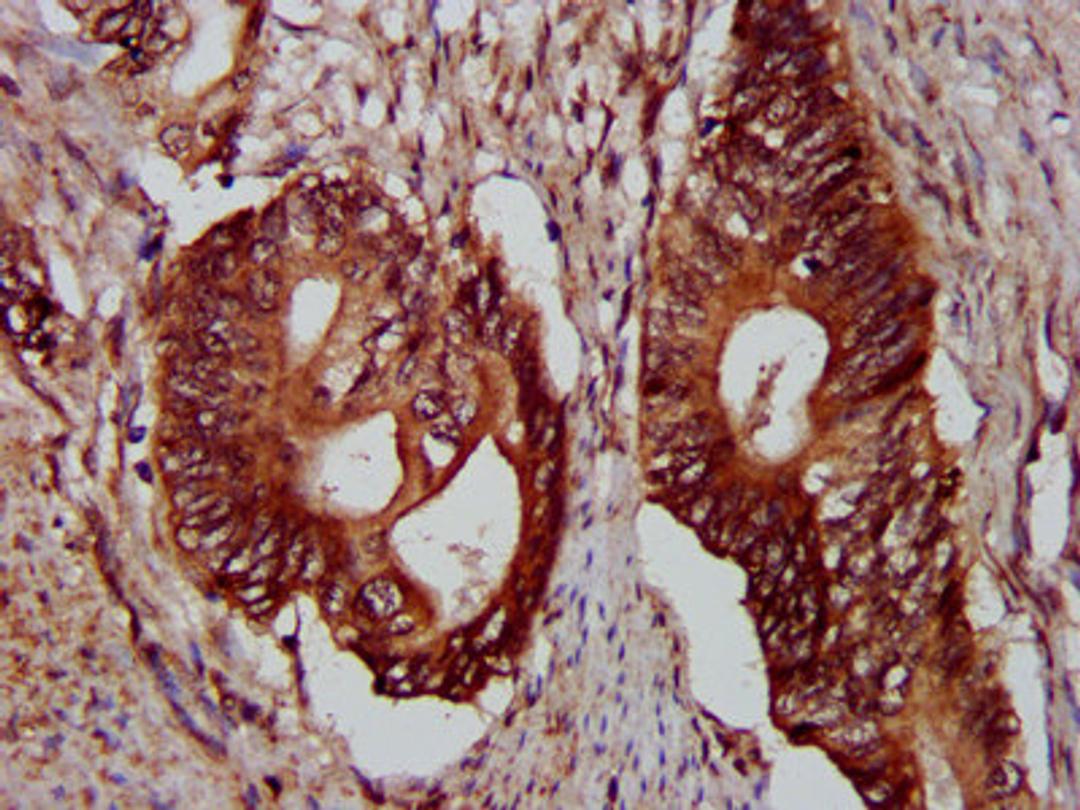IHC image of CSB-PA619965LA01HU diluted at 1:300 and staining in paraffin-embedded human colon cancer performed on a Leica BondTM system. After dewaxing and hydration, antigen retrieval was mediated by high pressure in a citrate buffer (pH 6.0). Section was blocked with 10% normal goat serum 30min at RT. Then primary antibody (1% BSA) was incubated at 4&deg;C overnight. The primary is detected by a biotinylated secondary antibody and visualized using an HRP conjugated SP system.