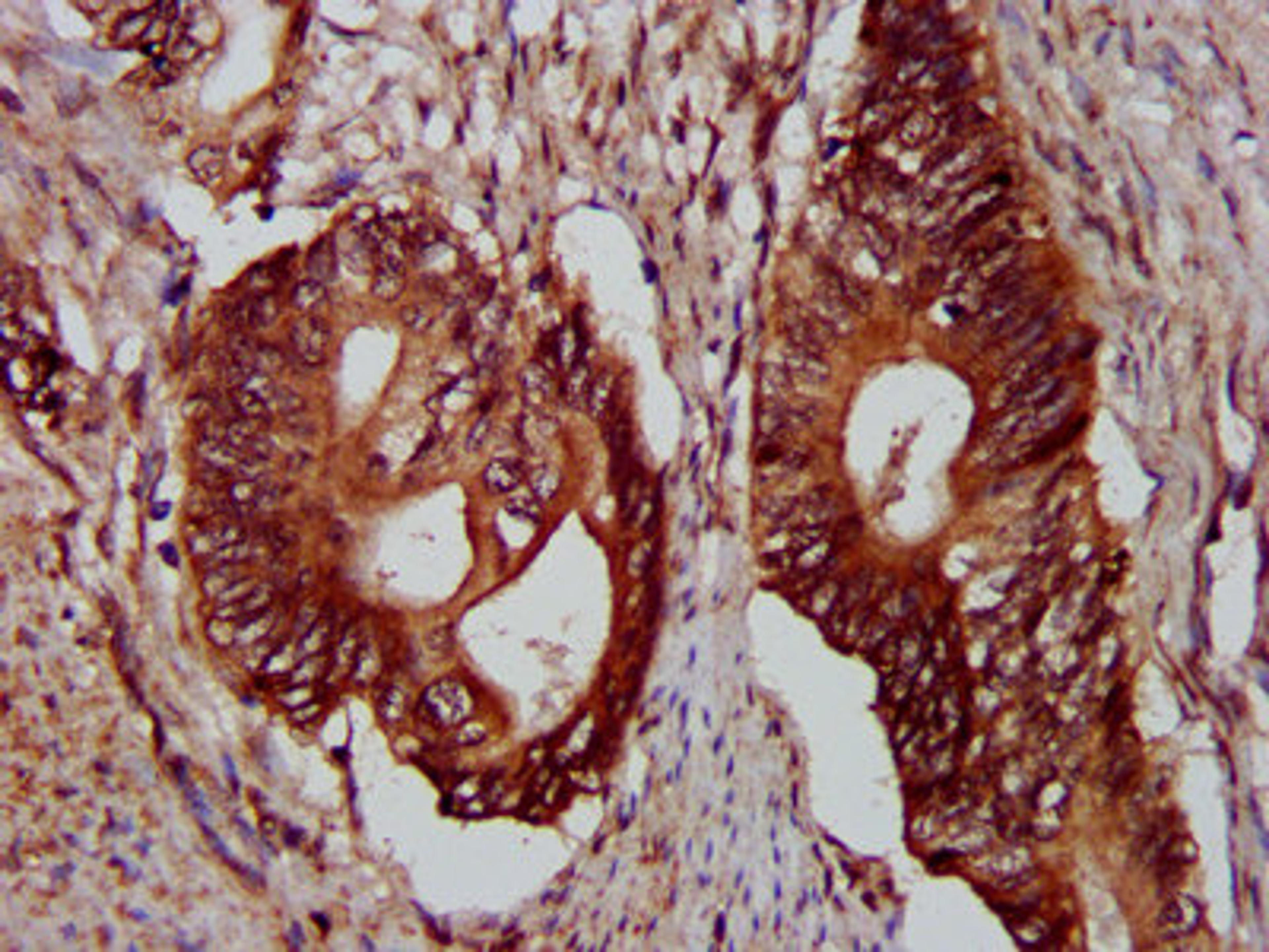 IHC image of CSB-PA619965LA01HU diluted at 1:300 and staining in paraffin-embedded human colon cancer performed on a Leica BondTM system. After dewaxing and hydration, antigen retrieval was mediated by high pressure in a citrate buffer (pH 6.0). Section was blocked with 10% normal goat serum 30min at RT. Then primary antibody (1% BSA) was incubated at 4&deg;C overnight. The primary is detected by a biotinylated secondary antibody and visualized using an HRP conjugated SP system.