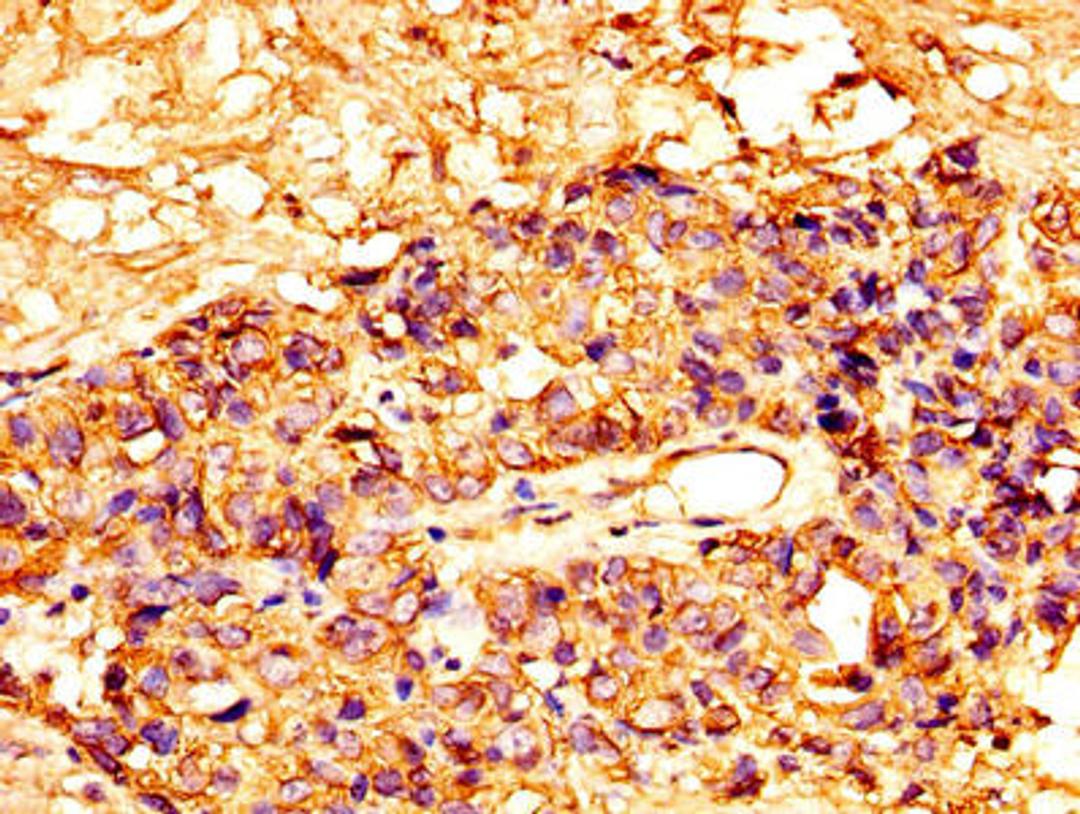 IHC image of CSB-PA10159A0Rb diluted at 1:300 and staining in paraffin-embedded human ovarian cancer performed on a Leica BondTM system. After dewaxing and hydration, antigen retrieval was mediated by high pressure in a citrate buffer (pH 6.0). Section was blocked with 10% normal goat serum 30min at RT. Then primary antibody (1% BSA) was incubated at 4&deg;C overnight. The primary is detected by a biotinylated secondary antibody and visualized using an HRP conjugated SP system.