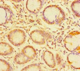 Immunohistochemistry of paraffin-embedded human gastric cancer using CSB-PA874834LA01HU at dilution of 1:100