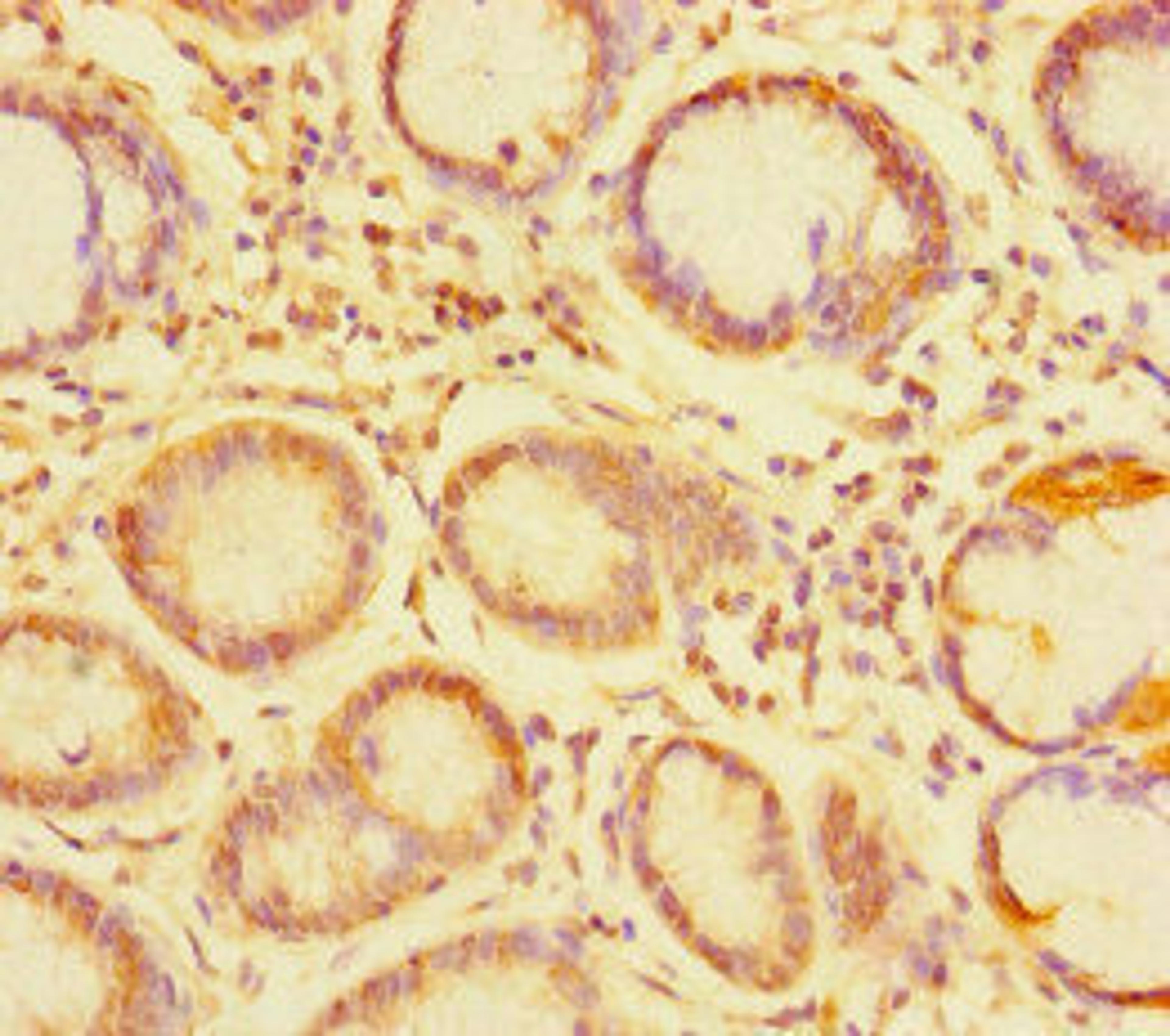 Immunohistochemistry of paraffin-embedded human gastric cancer using CSB-PA874834LA01HU at dilution of 1:100