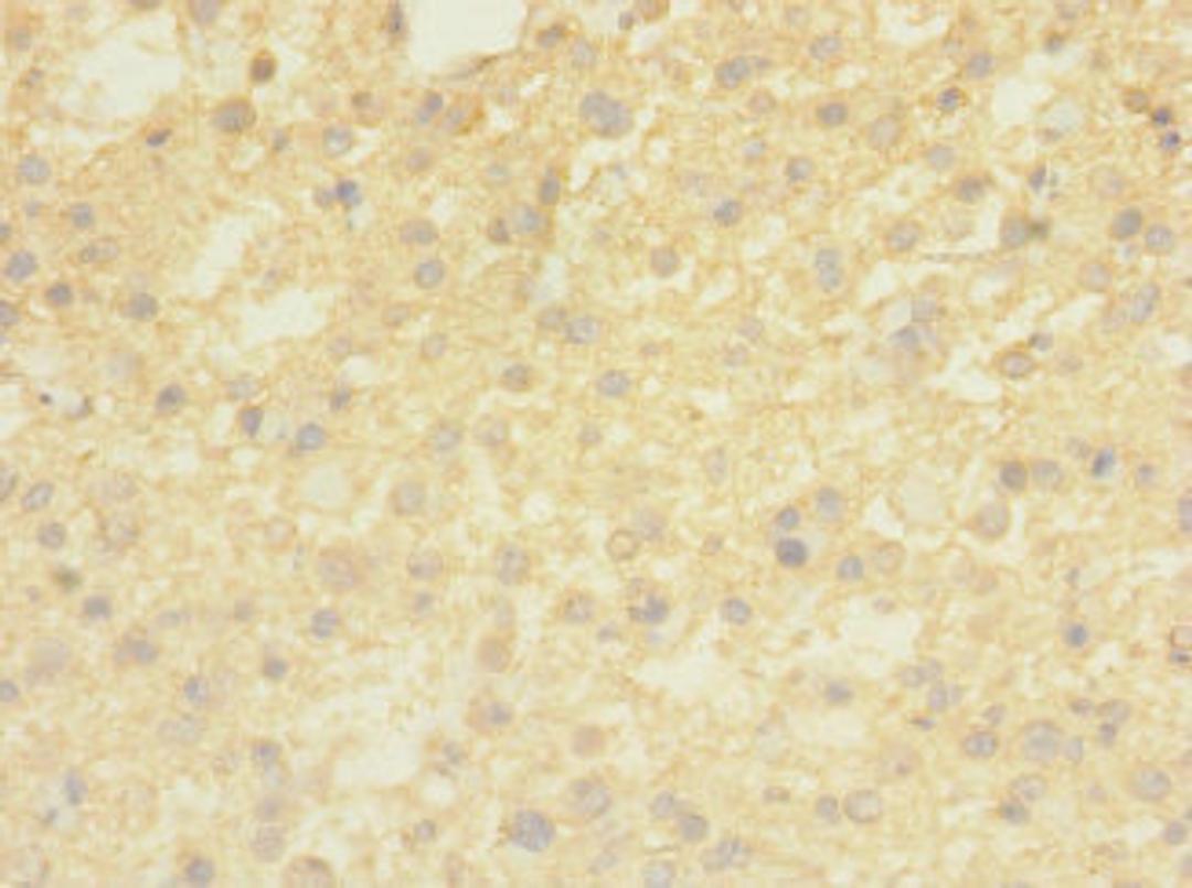 Immunohistochemistry of paraffin-embedded human glioma using CSB-PA023857LA01HU at dilution of 1:100
