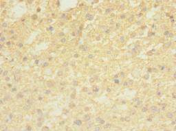 Immunohistochemistry of paraffin-embedded human glioma using CSB-PA023857LA01HU at dilution of 1:100