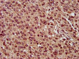 IHC image of CSB-PA875665LA01HU diluted at 1:300 and staining in paraffin-embedded human glioma performed on a Leica BondTM system. After dewaxing and hydration, antigen retrieval was mediated by high pressure in a citrate buffer (pH 6.0). Section was blocked with 10% normal goat serum 30min at RT. Then primary antibody (1% BSA) was incubated at 4&deg;C overnight. The primary is detected by a biotinylated secondary antibody and visualized using an HRP conjugated SP system.