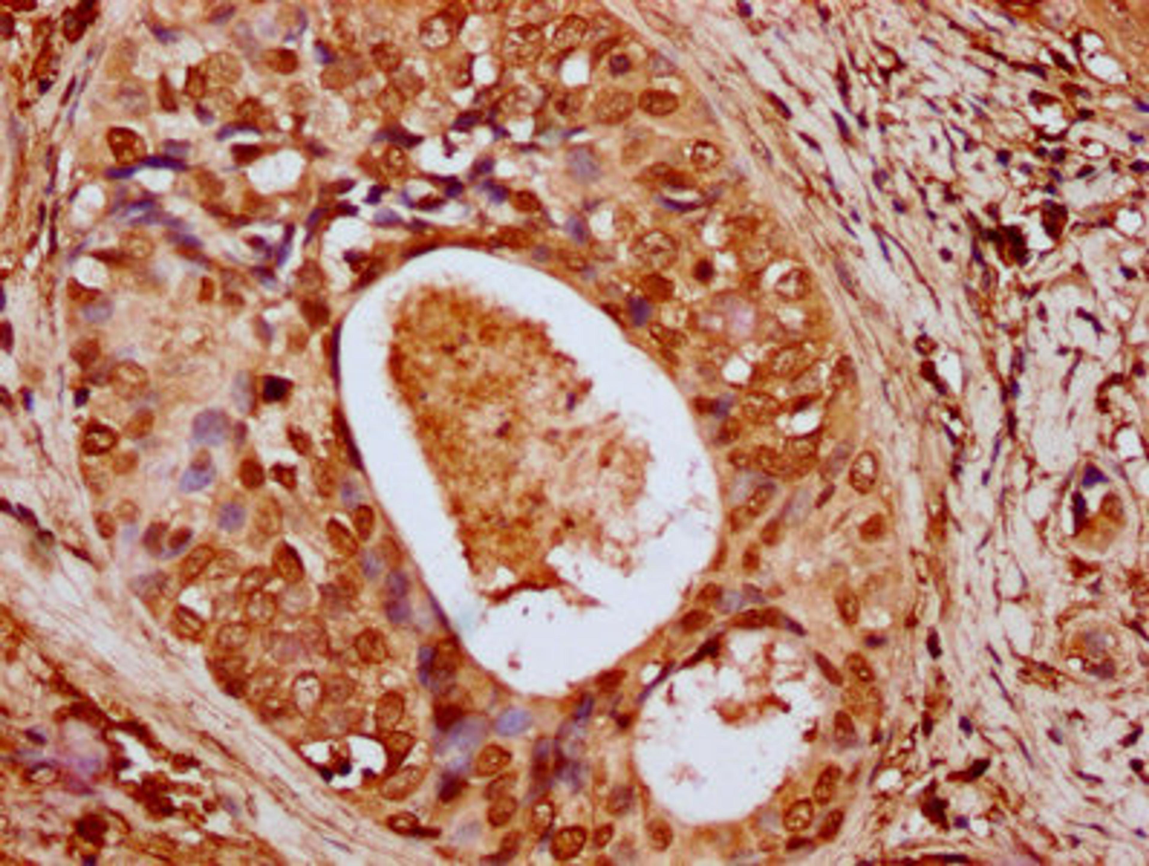 IHC image of CSB-PA010429OA79nhibHU diluted at 1:10 and staining in paraffin-embedded human cervical cancer performed on a Leica BondTM system. After dewaxing and hydration, antigen retrieval was mediated by high pressure in a citrate buffer (pH 6.0). Section was blocked with 10% normal goat serum 30min at RT. Then primary antibody (1% BSA) was incubated at 4&deg;C overnight. The primary is detected by a biotinylated secondary antibody and visualized using an HRP conjugated SP system.