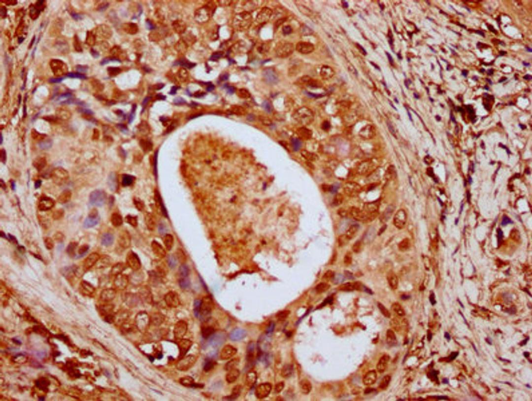 IHC image of CSB-PA010429OA79nhibHU diluted at 1:10 and staining in paraffin-embedded human cervical cancer performed on a Leica BondTM system. After dewaxing and hydration, antigen retrieval was mediated by high pressure in a citrate buffer (pH 6.0). Section was blocked with 10% normal goat serum 30min at RT. Then primary antibody (1% BSA) was incubated at 4°C overnight. The primary is detected by a biotinylated secondary antibody and visualized using an HRP conjugated SP system.