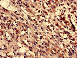 Immunohistochemistry analysis of human melanoma using CSB-PA883593LA01HU at dilution of 1:100