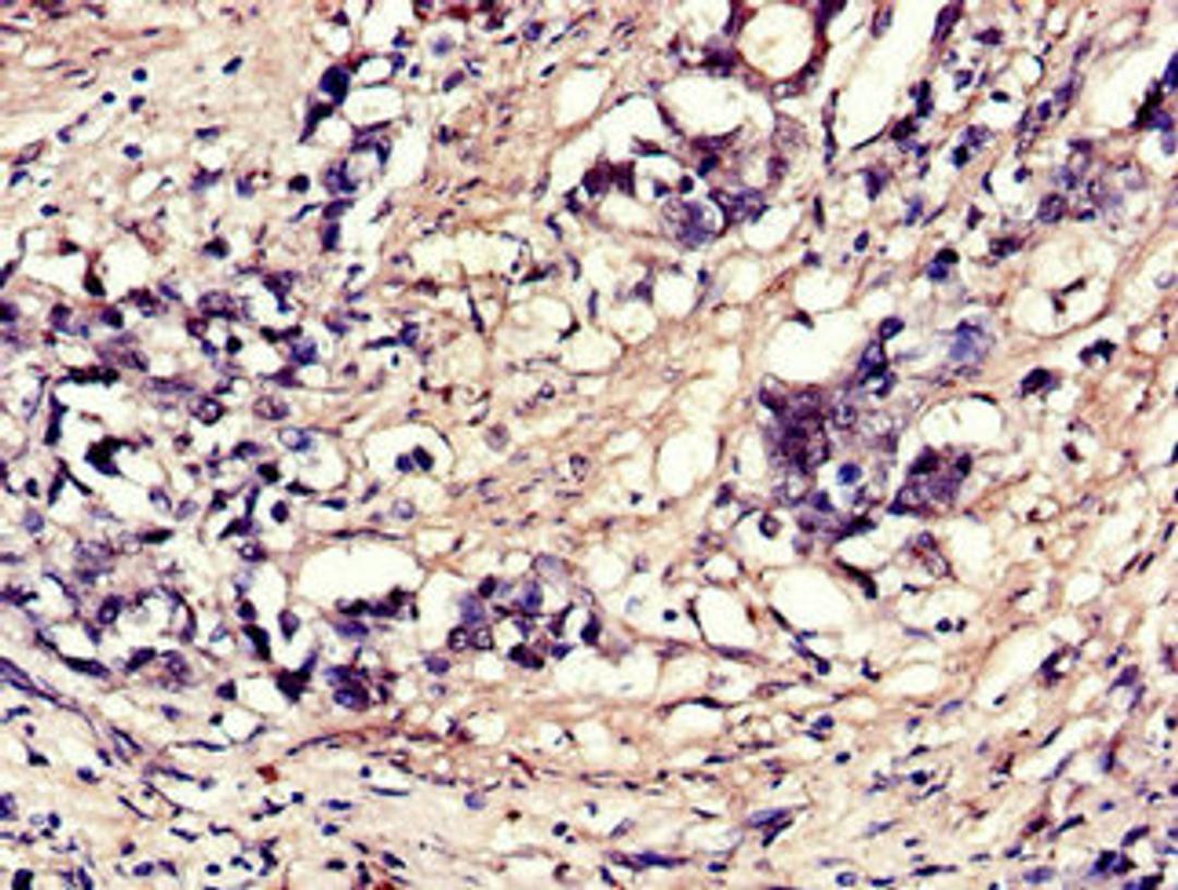 Immunohistochemistry of paraffin-embedded human gastric cancer using CSB-PA007553LA01HU at dilution of 1:100