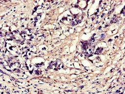 Immunohistochemistry of paraffin-embedded human gastric cancer using CSB-PA007553LA01HU at dilution of 1:100