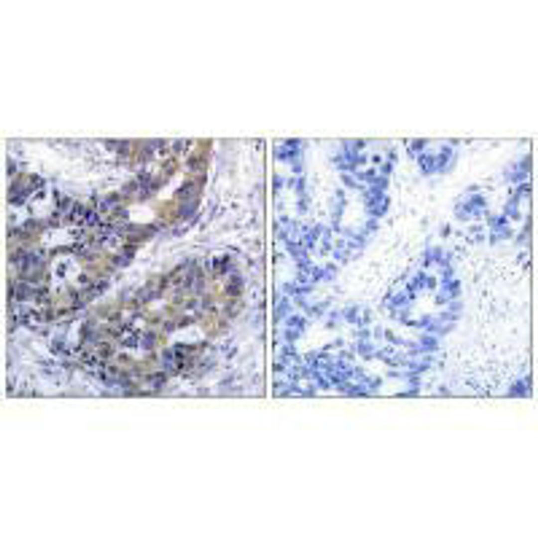 Immunohistochemistry analysis of paraffin-embedded human breast carcinoma tissue, using IRS-1 (Ab-312) antibody.