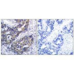 Immunohistochemistry analysis of paraffin-embedded human breast carcinoma tissue, using IRS-1 (Ab-312) antibody.