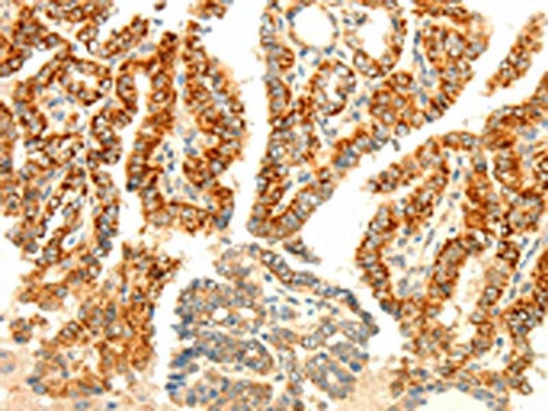 The image on the left is immunohistochemistry of paraffin-embedded Human thyroid cancer tissue using CSB-PA944776(AARS2 Antibody) at dilution 1/80, on the right is treated with fusion protein. (Original magnification: ×200)