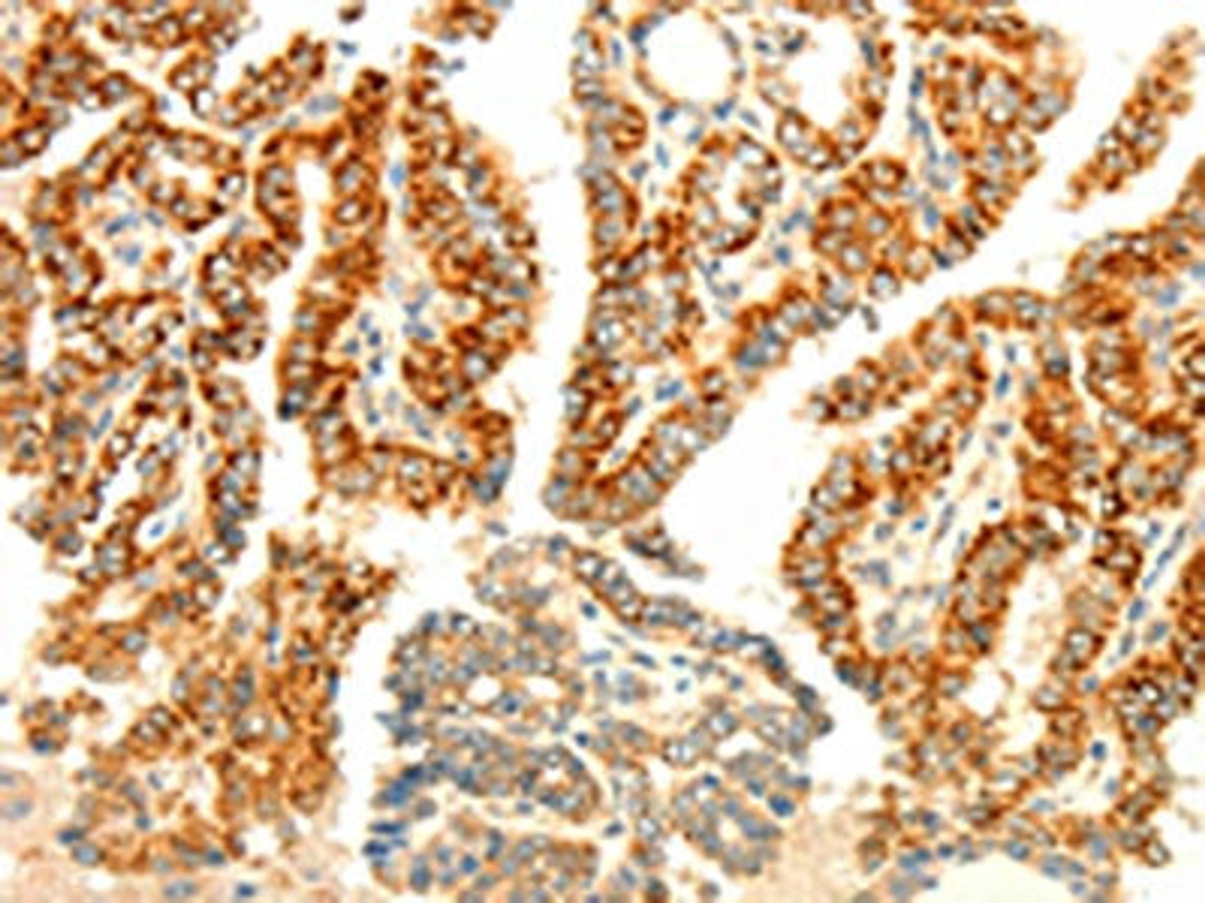 The image on the left is immunohistochemistry of paraffin-embedded Human thyroid cancer tissue using CSB-PA944776(AARS2 Antibody) at dilution 1/80, on the right is treated with fusion protein. (Original magnification: ×200)
