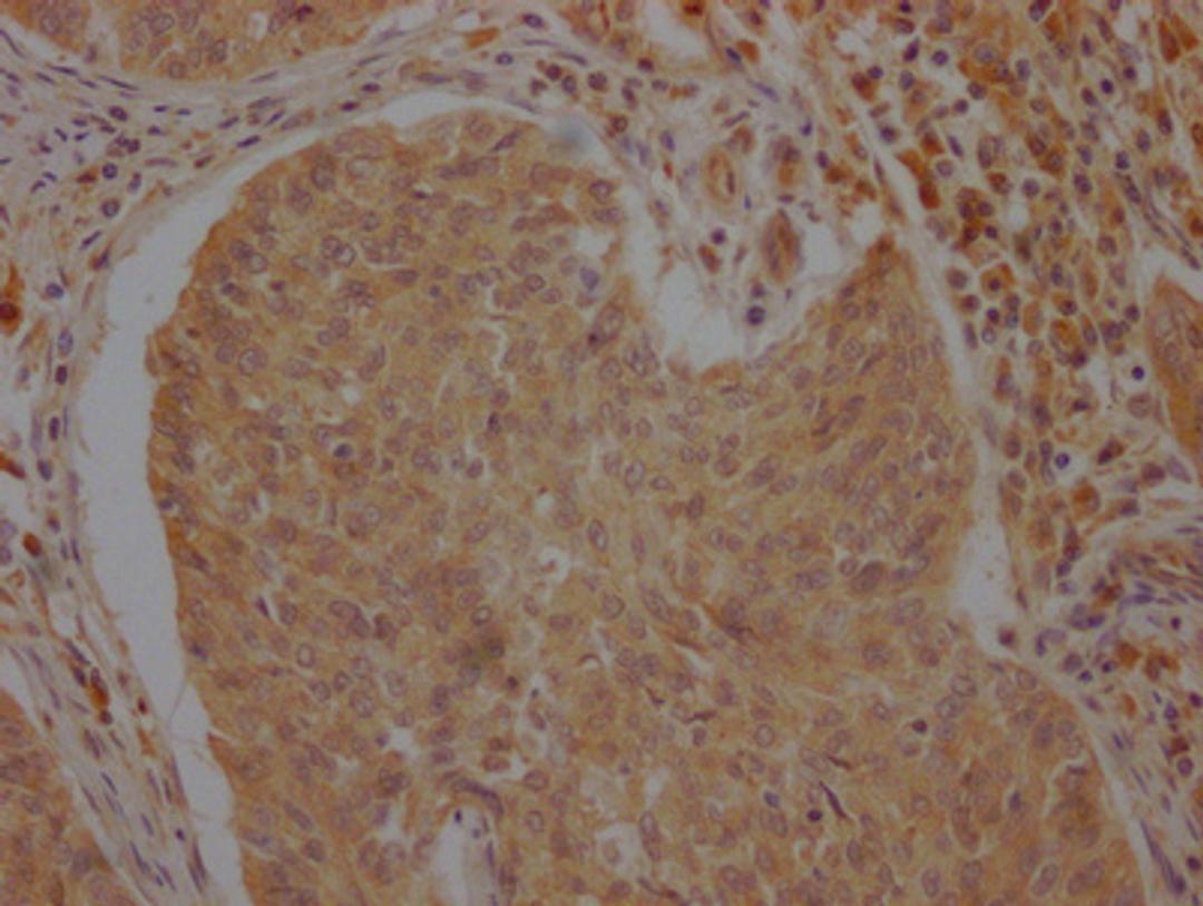IHC image of CSB-PA002277LA01HU diluted at 1:100 and staining in paraffin-embedded human cervical cancer performed on a Leica BondTM system. After dewaxing and hydration, antigen retrieval was mediated by high pressure in a citrate buffer (pH 6.0). Section was blocked with 10% normal goat serum 30min at RT. Then primary antibody (1% BSA) was incubated at 4°C overnight. The primary is detected by a Goat anti-rabbit polymer IgG labeled by HRP and visualized using 0.05% DAB.