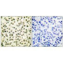 Immunohistochemical analysis of paraffin-embedded human breast carcinoma tissue using Ku70/80 antibody.
