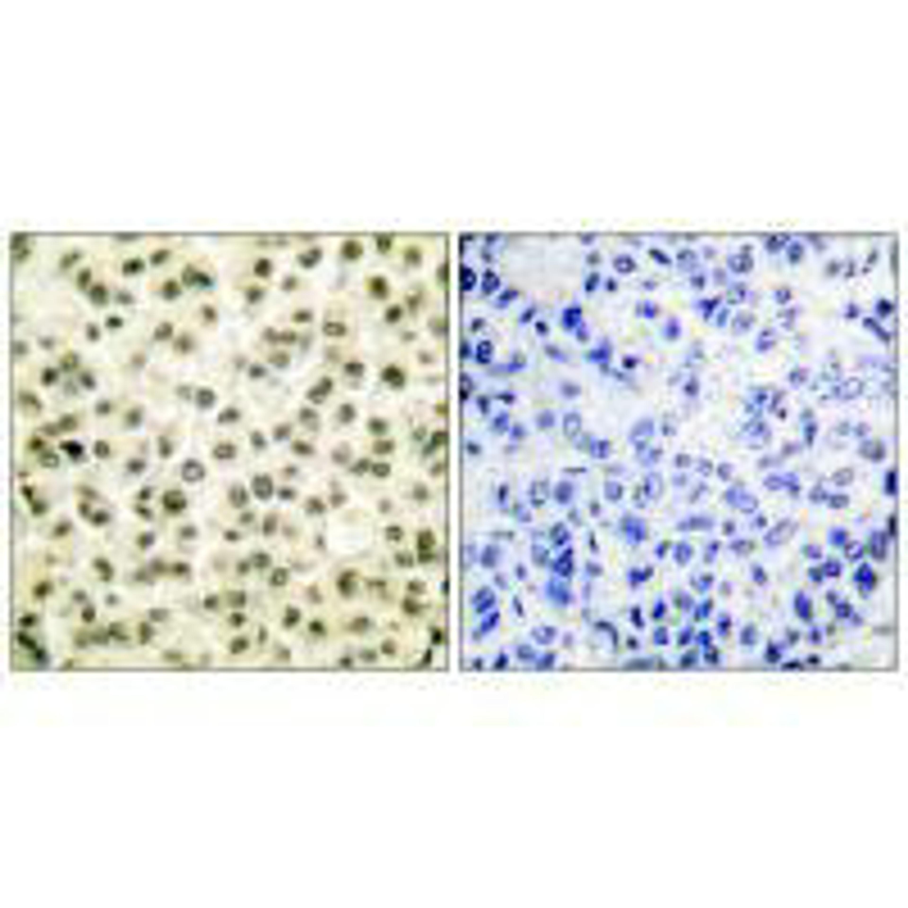 Immunohistochemical analysis of paraffin-embedded human breast carcinoma tissue using Ku70/80 antibody.