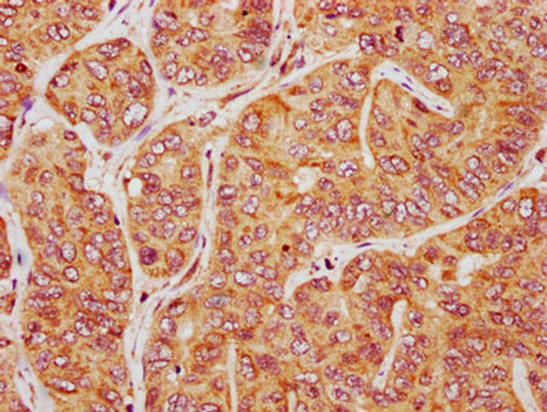 IHC image of CSB-PA314551LA01HU diluted at 1:200 and staining in paraffin-embedded human liver cancer performed on a Leica BondTM system. After dewaxing and hydration, antigen retrieval was mediated by high pressure in a citrate buffer (pH 6.0). Section was blocked with 10% normal goat serum 30min at RT. Then primary antibody (1% BSA) was incubated at 4&deg;C overnight. The primary is detected by a biotinylated secondary antibody and visualized using an HRP conjugated SP system.