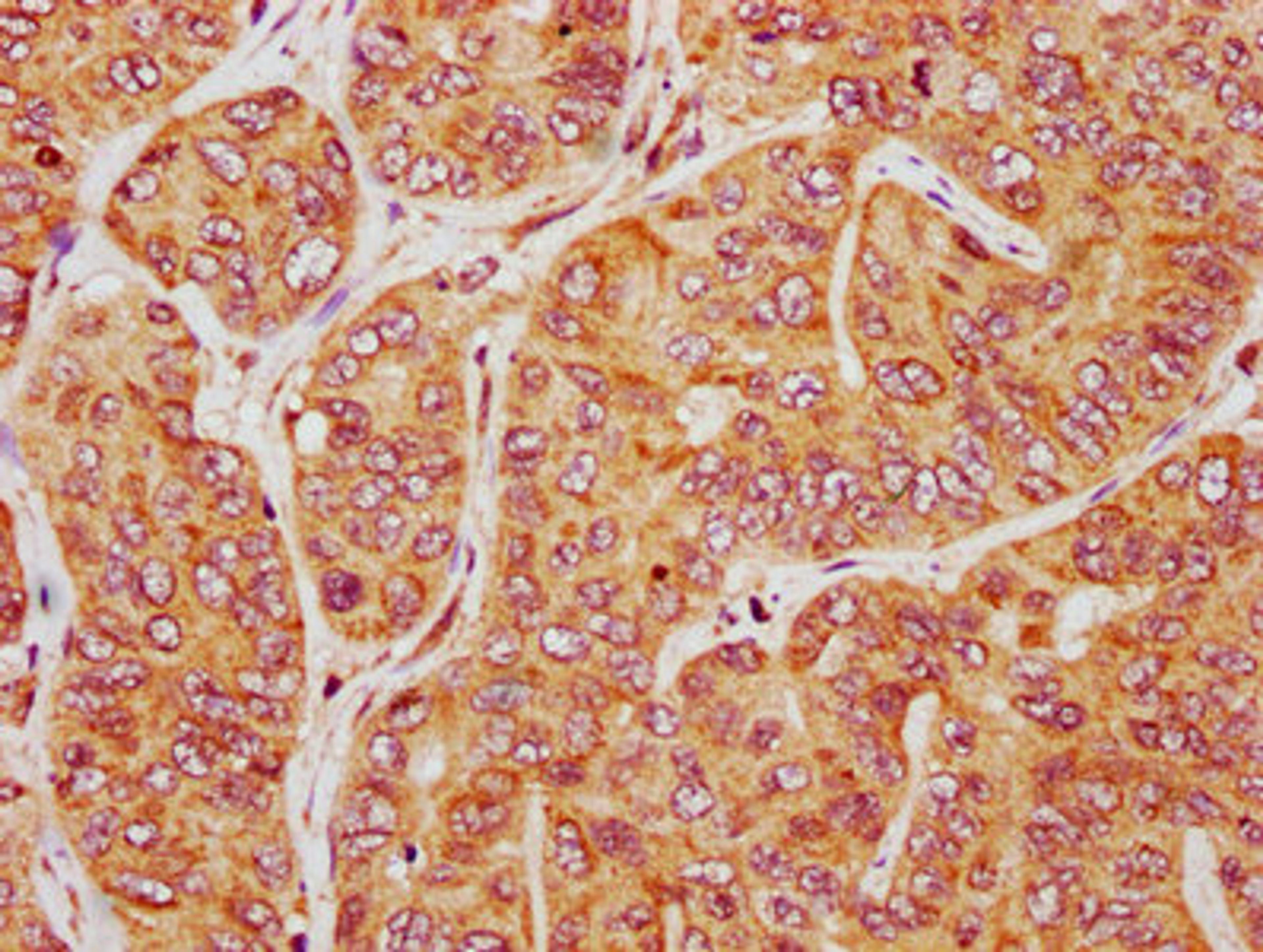 IHC image of CSB-PA314551LA01HU diluted at 1:200 and staining in paraffin-embedded human liver cancer performed on a Leica BondTM system. After dewaxing and hydration, antigen retrieval was mediated by high pressure in a citrate buffer (pH 6.0). Section was blocked with 10% normal goat serum 30min at RT. Then primary antibody (1% BSA) was incubated at 4&deg;C overnight. The primary is detected by a biotinylated secondary antibody and visualized using an HRP conjugated SP system.