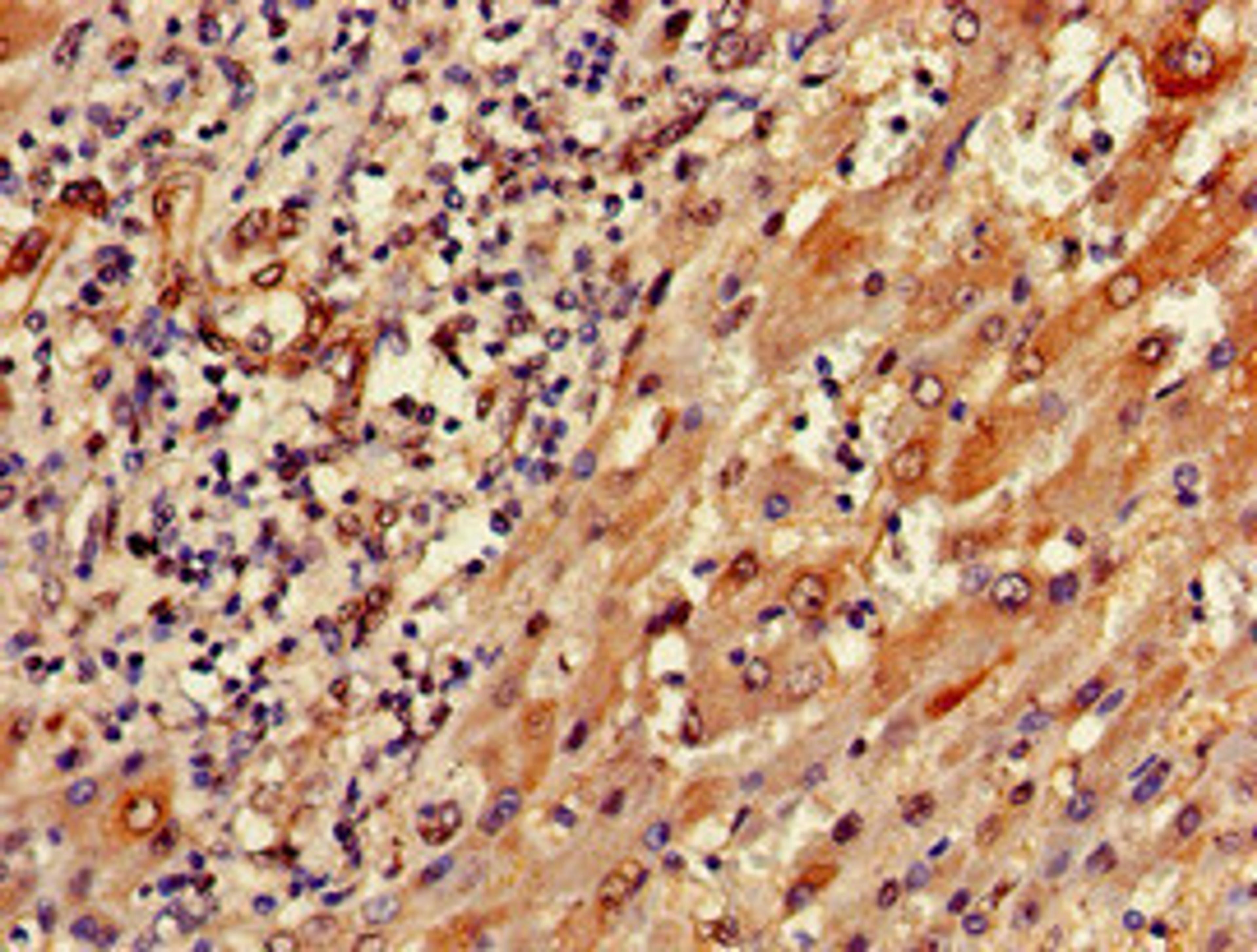 Immunohistochemistry of paraffin-embedded human liver cancer using CSB-PA875655YA01HU at dilution of 1:100