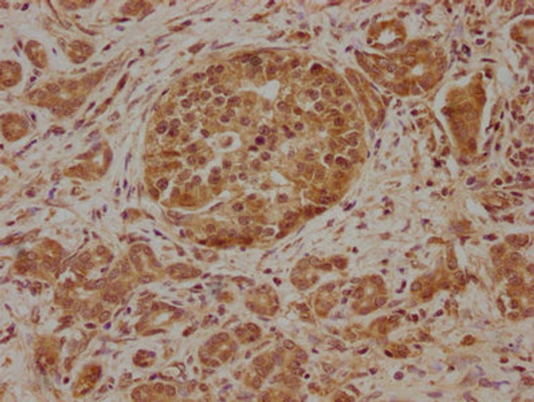 IHC image of CSB-PA891736LA01HU diluted at 1:100 and staining in paraffin-embedded human pancreatic cancer performed on a Leica BondTM system. After dewaxing and hydration, antigen retrieval was mediated by high pressure in a citrate buffer (pH 6.0). Section was blocked with 10% normal goat serum 30min at RT. Then primary antibody (1% BSA) was incubated at 4°C overnight. The primary is detected by a biotinylated secondary antibody and visualized using an HRP conjugated SP system.