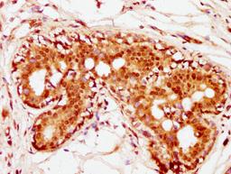 IHC image of CSB-PA010389PA36nhibHU diluted at 1:10 and staining in paraffin-embedded human breast cancer performed on a Leica BondTM system. After dewaxing and hydration, antigen retrieval was mediated by high pressure in a citrate buffer (pH 6.0). Section was blocked with 10% normal goat serum 30min at RT. Then primary antibody (1% BSA) was incubated at 4°C overnight. The primary is detected by a biotinylated secondary antibody and visualized using an HRP conjugated SP system.