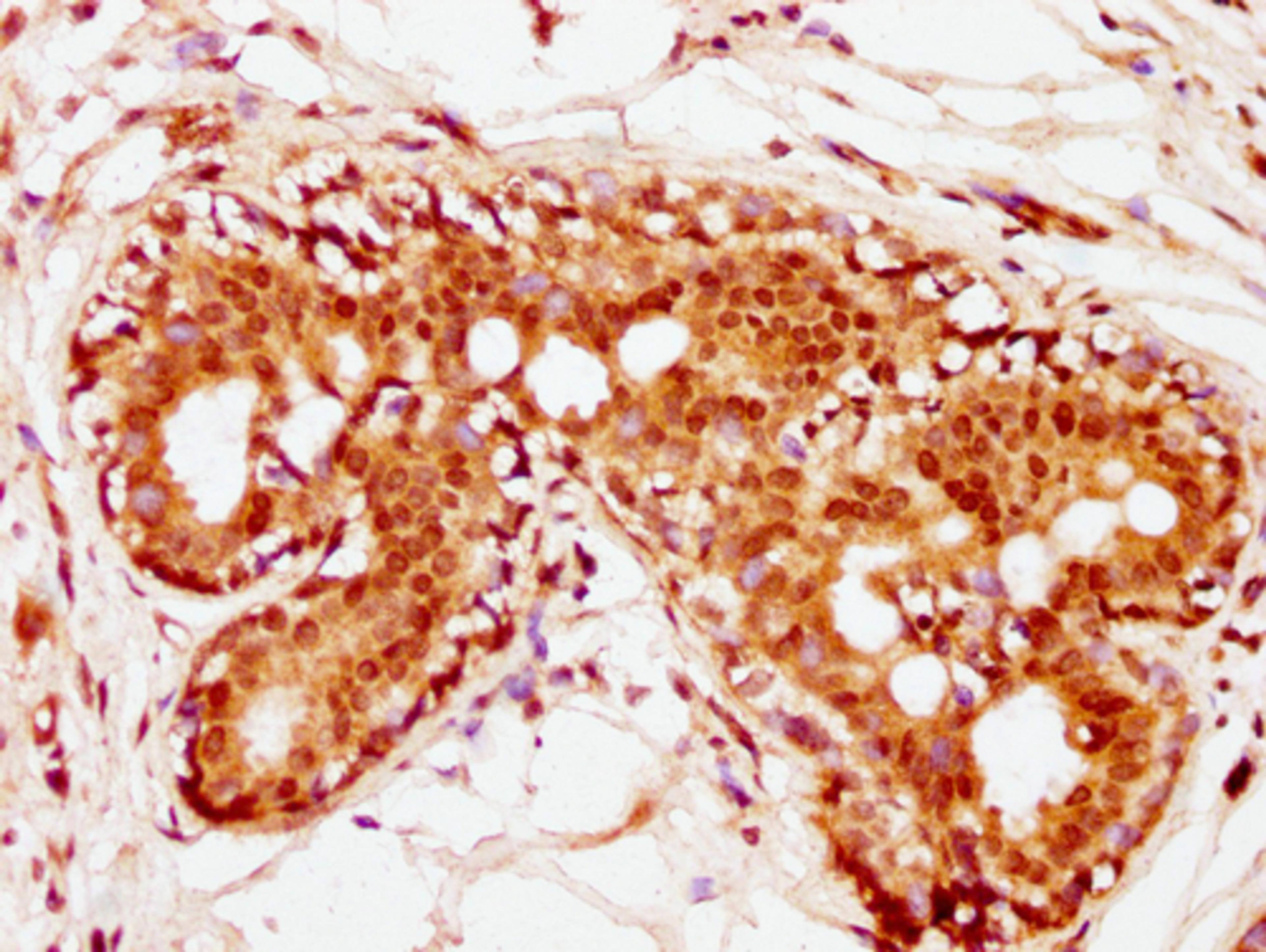 IHC image of CSB-PA010389PA36nhibHU diluted at 1:10 and staining in paraffin-embedded human breast cancer performed on a Leica BondTM system. After dewaxing and hydration, antigen retrieval was mediated by high pressure in a citrate buffer (pH 6.0). Section was blocked with 10% normal goat serum 30min at RT. Then primary antibody (1% BSA) was incubated at 4°C overnight. The primary is detected by a biotinylated secondary antibody and visualized using an HRP conjugated SP system.
