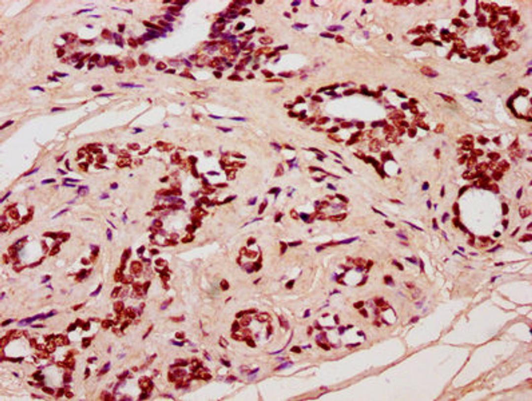 IHC image of CSB-PA010429OA91nforHU diluted at 1:20 and staining in paraffin-embedded human breast cancer performed on a Leica BondTM system. After dewaxing and hydration, antigen retrieval was mediated by high pressure in a citrate buffer (pH 6.0). Section was blocked with 10% normal goat serum 30min at RT. Then primary antibody (1% BSA) was incubated at 4&deg;C overnight. The primary is detected by a biotinylated secondary antibody and visualized using an HRP conjugated SP system.