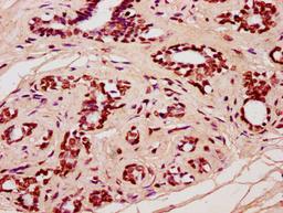IHC image of CSB-PA010429OA91nforHU diluted at 1:20 and staining in paraffin-embedded human breast cancer performed on a Leica BondTM system. After dewaxing and hydration, antigen retrieval was mediated by high pressure in a citrate buffer (pH 6.0). Section was blocked with 10% normal goat serum 30min at RT. Then primary antibody (1% BSA) was incubated at 4&deg;C overnight. The primary is detected by a biotinylated secondary antibody and visualized using an HRP conjugated SP system.